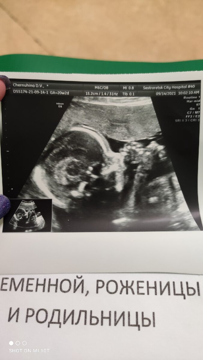 УЗИ со второго скрининга