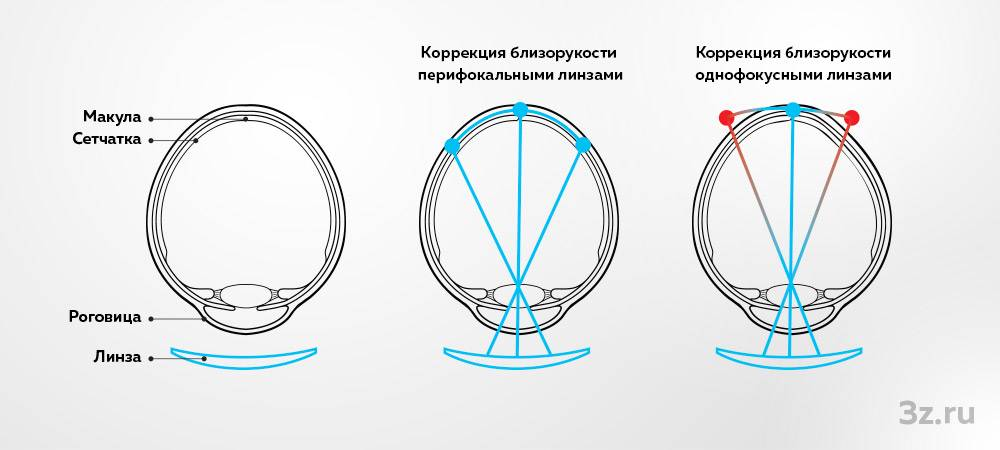 Принцип работы перифокальных линз