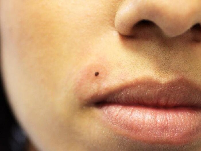 Фото Бородавки на лице.