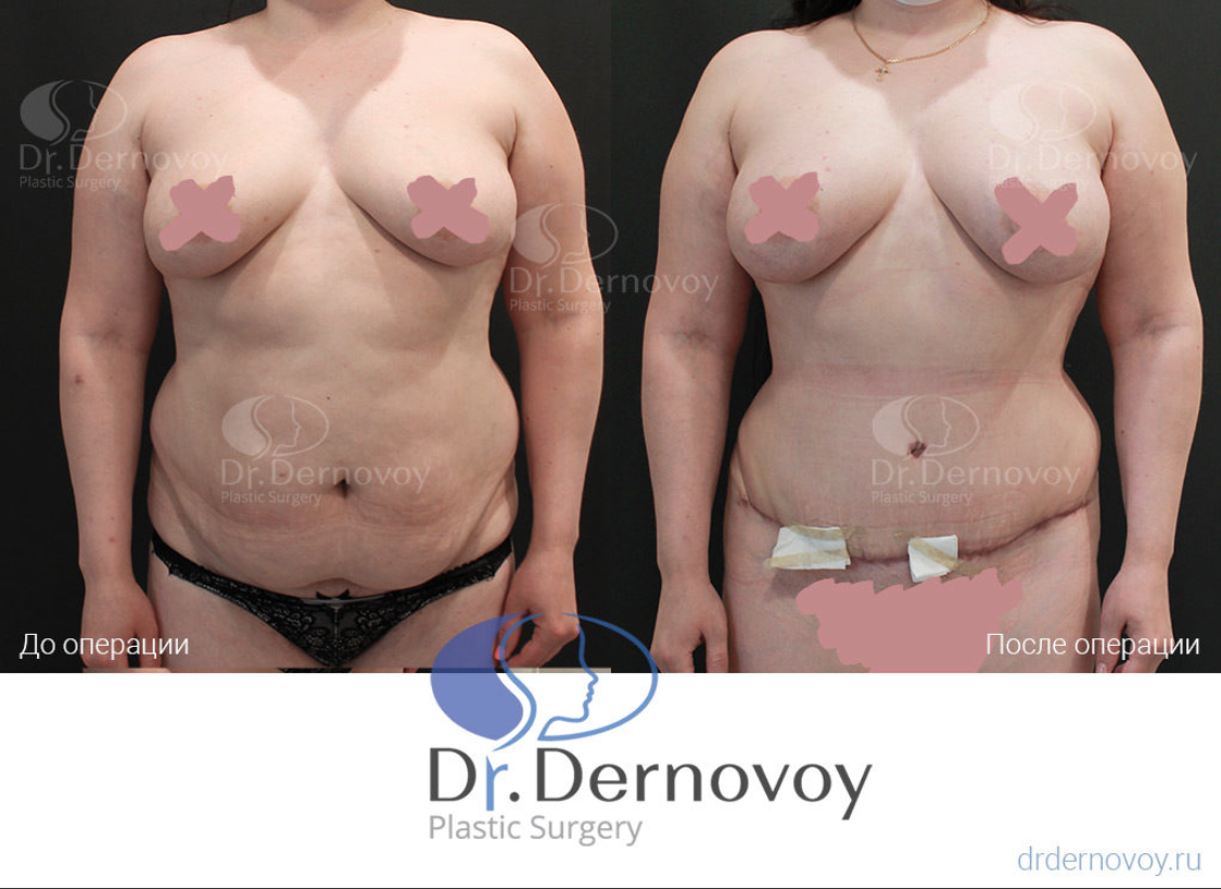 Абдоминопластика + липофилинг