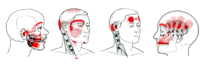 Триггерные точки на лице фото