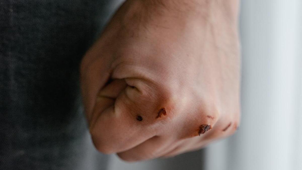    Кулак со ссадинами:pexels.com