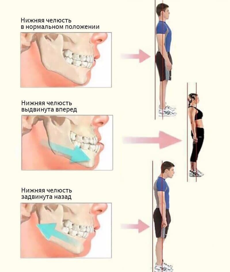 Нижняя челюсть стала выдвигаться вперед. Почему это происходит? | Альянс бьюти cтоматологов, Москва
