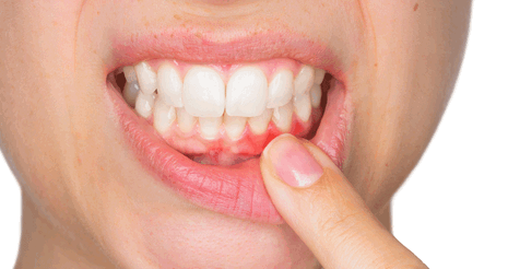 Воспаление десны 