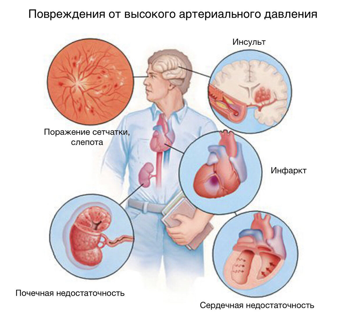 Артериальная гипертензия - важные факты, о которых должен знать каждый. |  Медицинская онлайн-школа МедикУм | Дзен