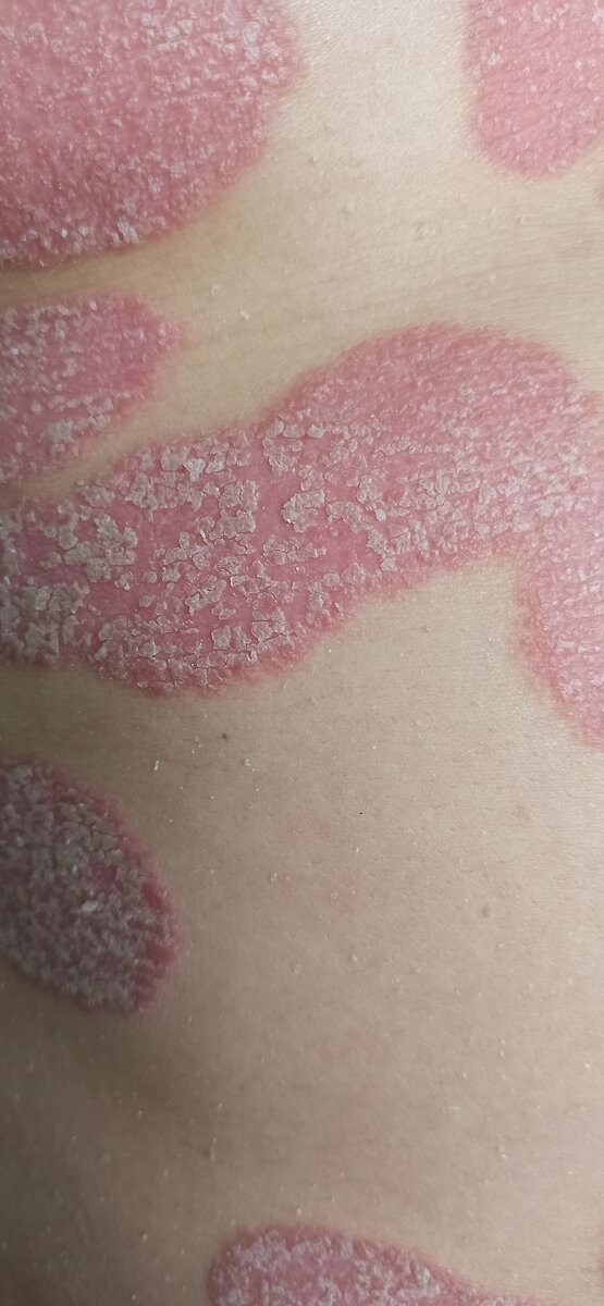 Мужчина 26 лет. Болеет 3 года. 