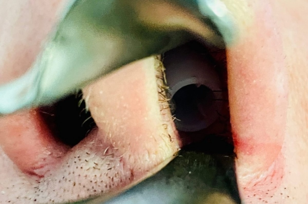    Ишимец попал в больницу с колпачком от капель в носу