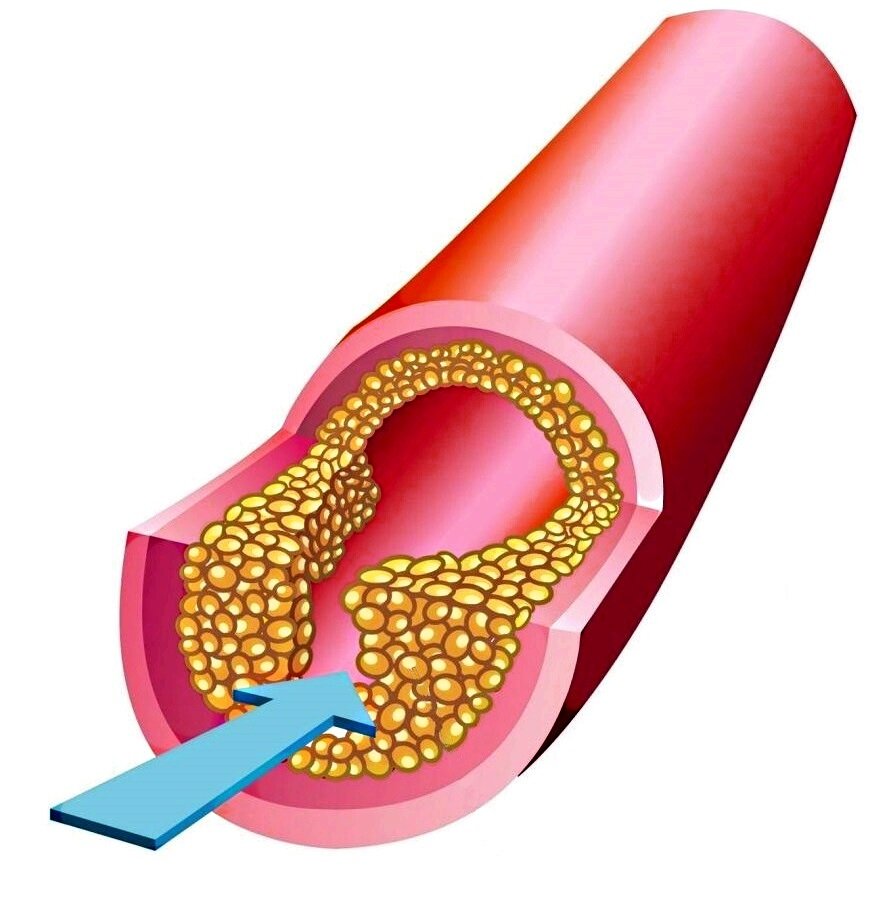 Симптомы склероза сосудов. Холестериновые бляшки в сосудах. Атеросклерозная бляшка в сосуде. Атеросклероз бляшки сосудов. Атеросклероз (закупорка кровеносных сосудов).