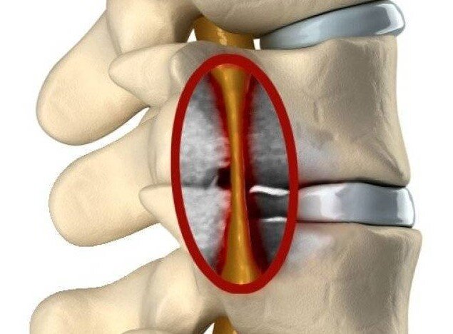Стеноз позвоночного канала что это такое и как лечить симптомы фото