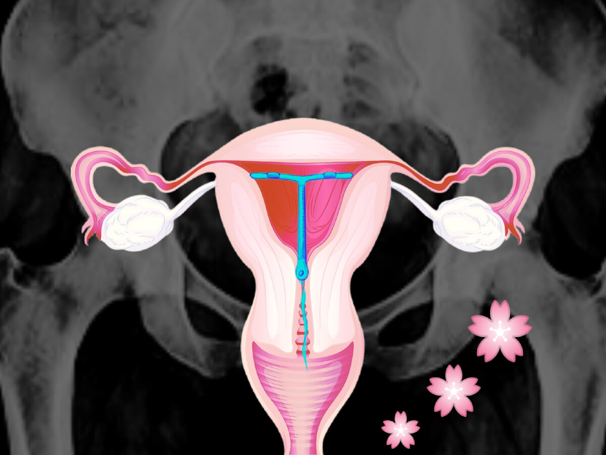 Внутриматочная спираль – все об этом виде контрацепции