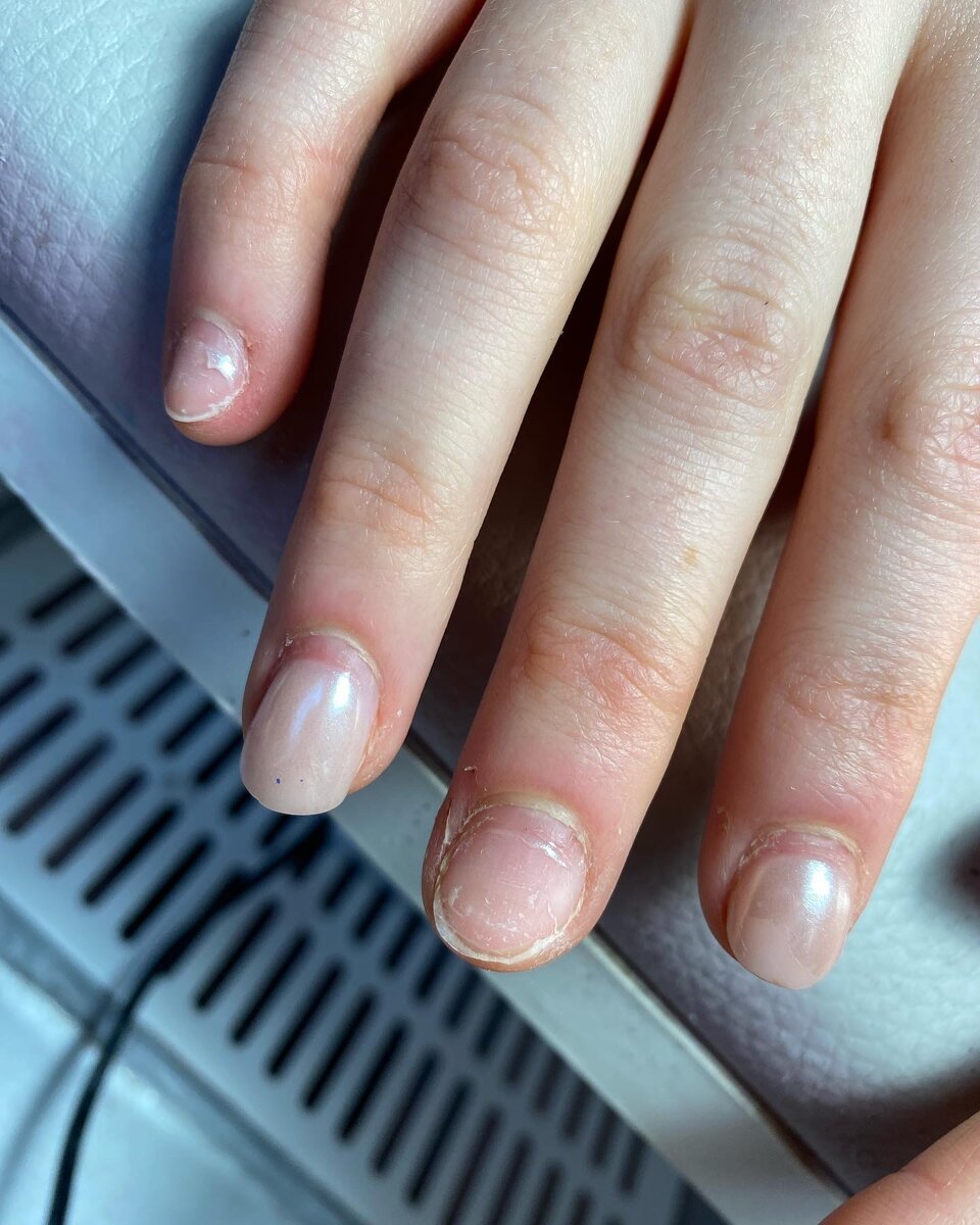 Так же стоит внимательно относиться к выбору своего мастера. На фотографиях «До» хорошо видны все бороздки, ямки, краснота ногтей и разросшаяся, неухоженная кутикула. Ноготки травмированы, ещё бы пару раз подобного маникюра, и не видать клиенту покрытия до полного восстановления ногтей. 