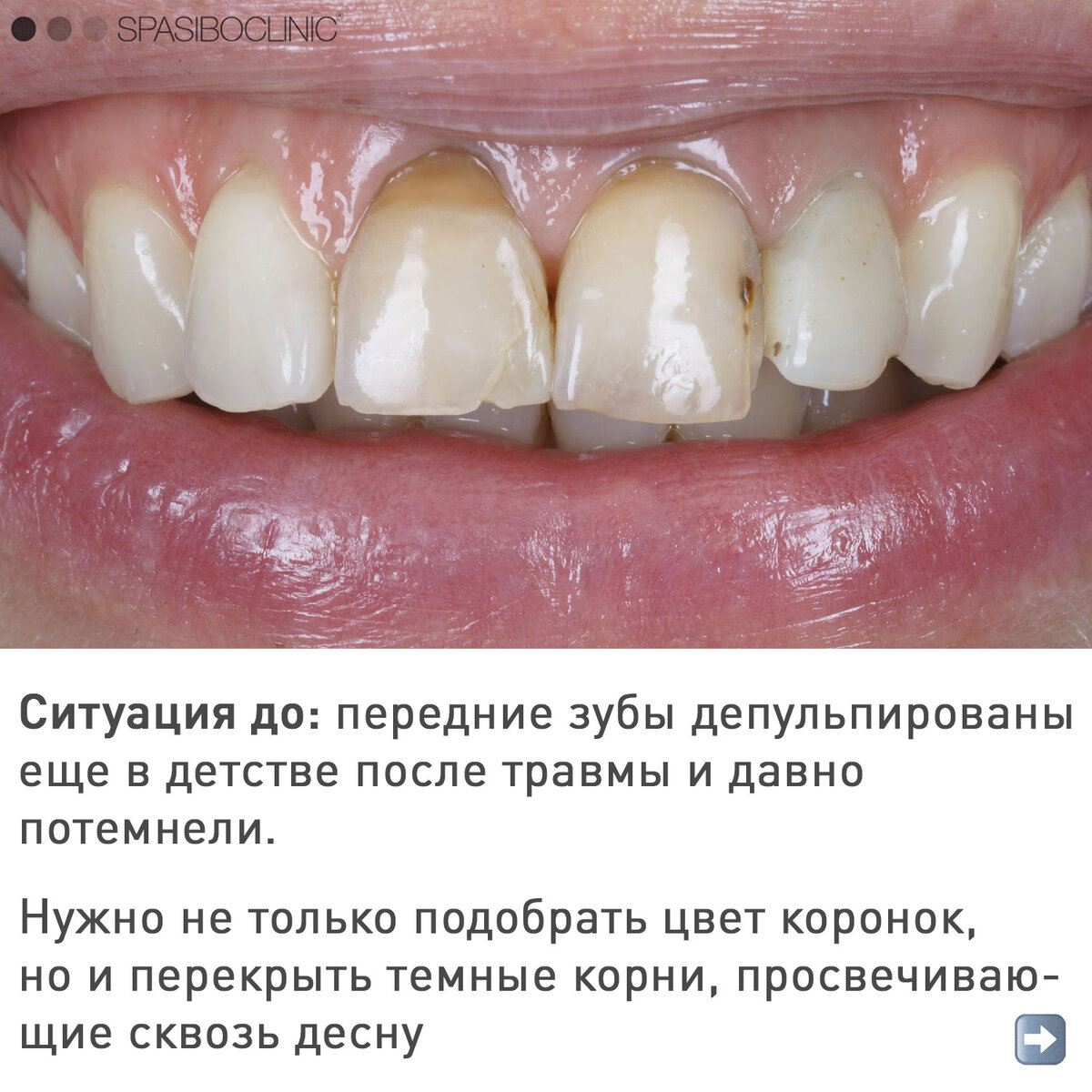 Почему «темнеют» зубы?