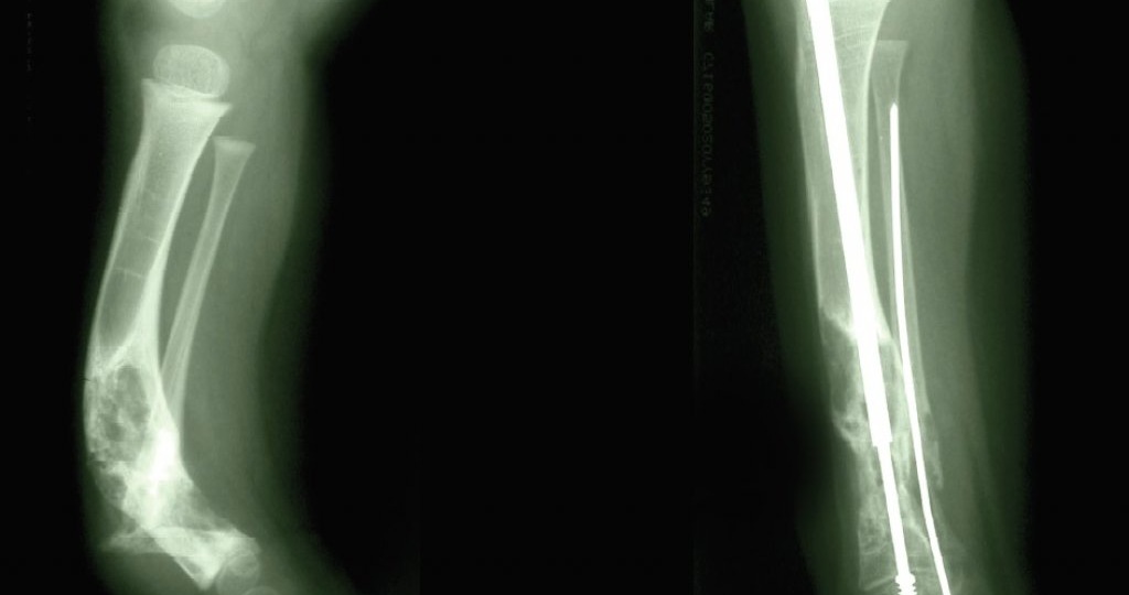 В Самаре впервые провели операцию с применением телескопических штифтов Fassier-Duval