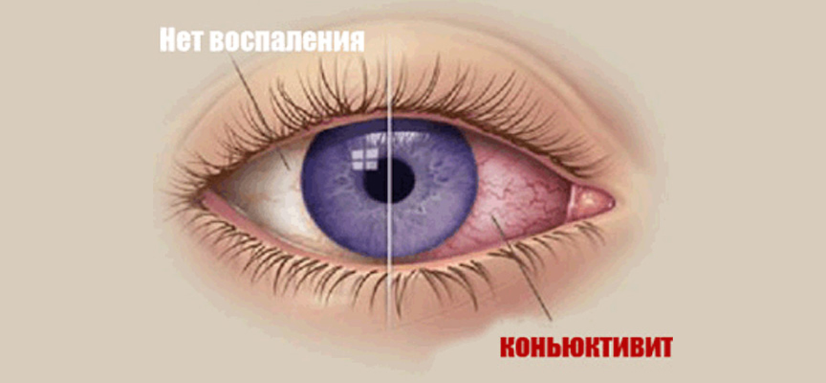 Что будет, если носить линзы дольше положенного срока? | Блог интернет-магазина sirius-clean.ru