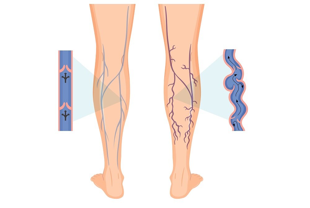 Варикозная болезнь нижних конечностей. Венотоники при варикозе.