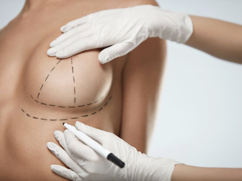 Коррекция груди самая популярная пластика