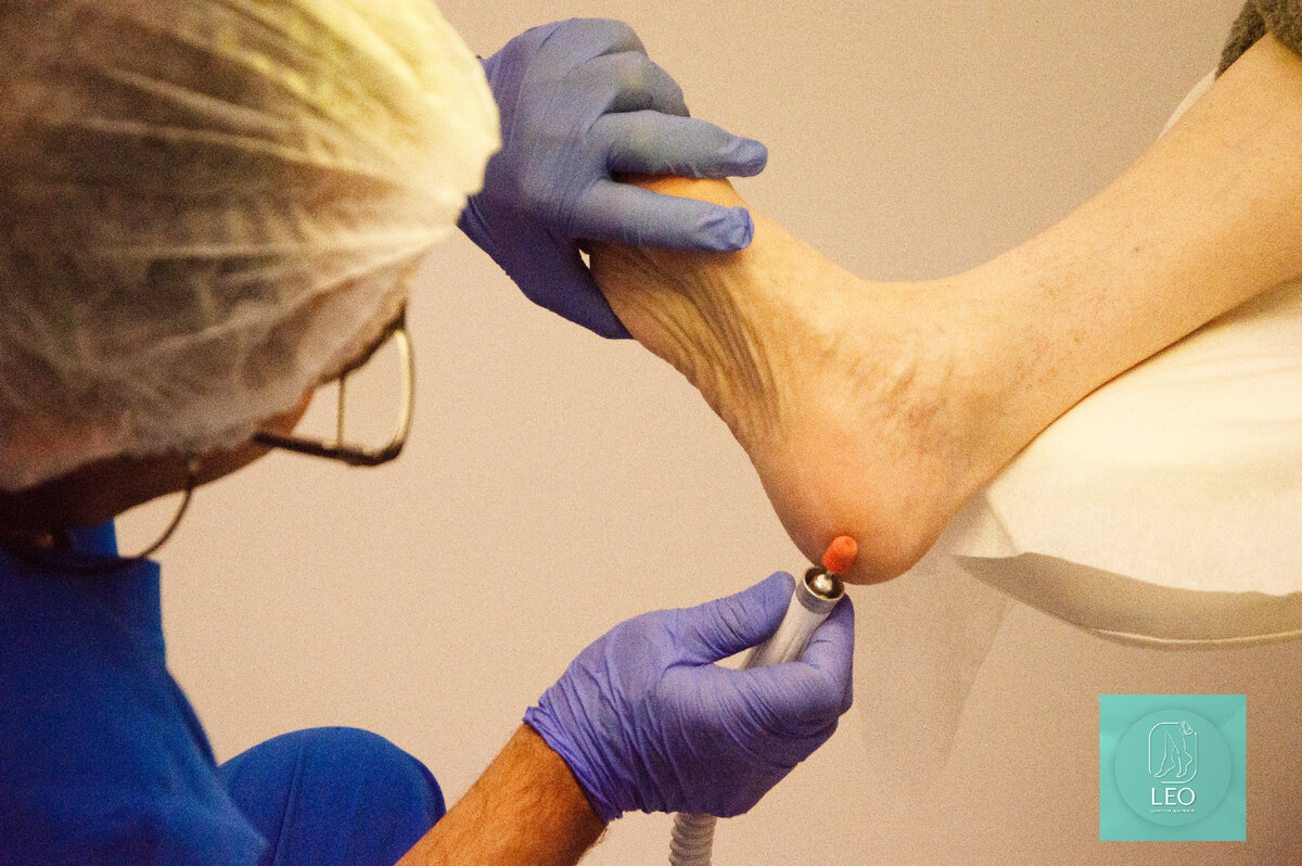 Профессиональная обработка стопы в мед.центре подологии Лео Бьюти 