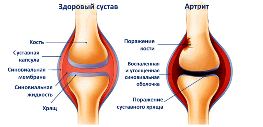 Синовиальный сустав. Артрит коленного сустава схема. Синовиальная мембрана коленного сустава. Строение синовиальной оболочки сустава. Ревматоидный артрит сустава рисунок.