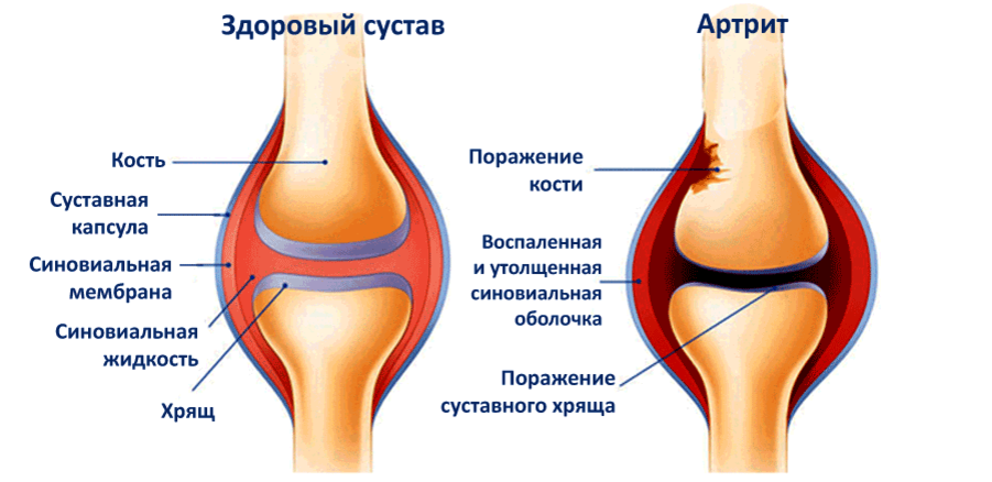 Артрит коленного сустава схема. Синовиальная оболочка коленного сустава. Синовиальная мембрана коленного сустава. Строение сустава синовиальная оболочка.