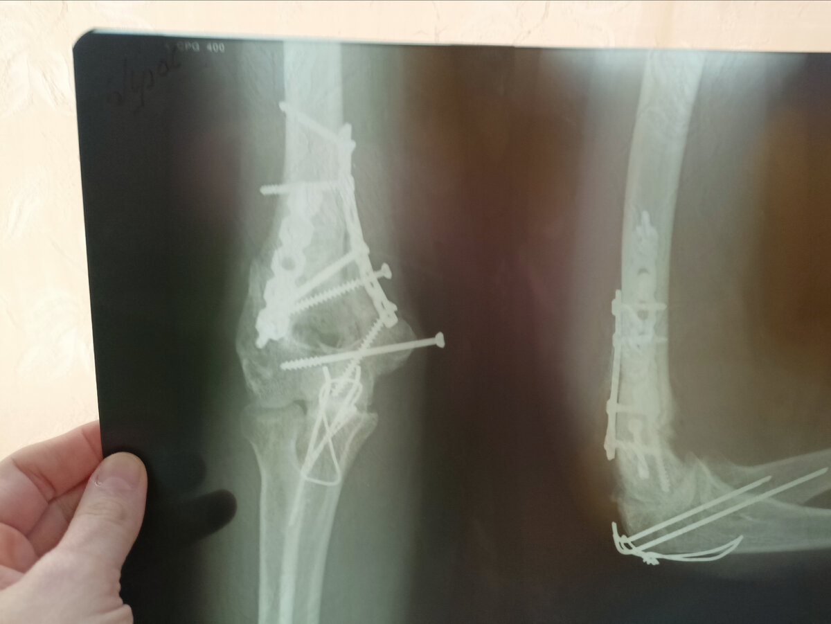 Рука киборга. Шурупы, пластины, спицы и проволока