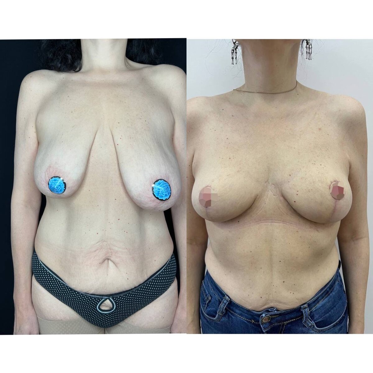 как называется операция по уменьшению груди у женщин фото 13