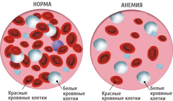 Анемия больные. Анемия железодефицитная эритроциты в крови. Железодефицитная анемия эритроциты в норме. Структура крови человека с железодефицитной анемией. Жда эритроциты норма.