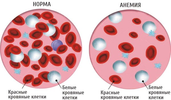 Гемоглобин и эритроциты при железодефицитной анемии. Анемия железодефицитная нормы железа. Эритроциты при жда у детей. Гемоглобин при железодефицитной анемии у детей.