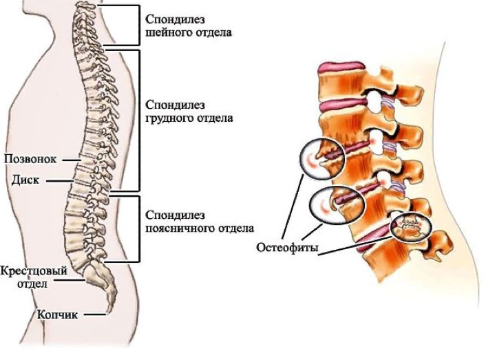 Стадии остеохондроза позвоночника картинки