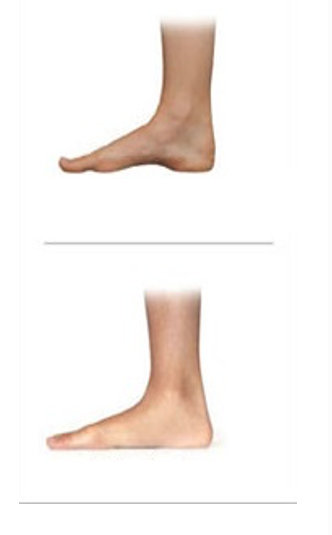 Вверху - правильно сформированный внутренний продольный свод стопы; внизу - продольный свод отсутствует, депрессия подсводного пространства 