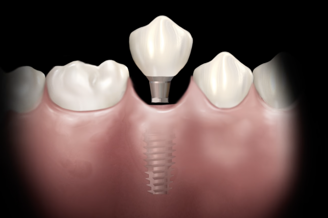 Временная коронка на имплантат. Автор фото BlueSky Bio 