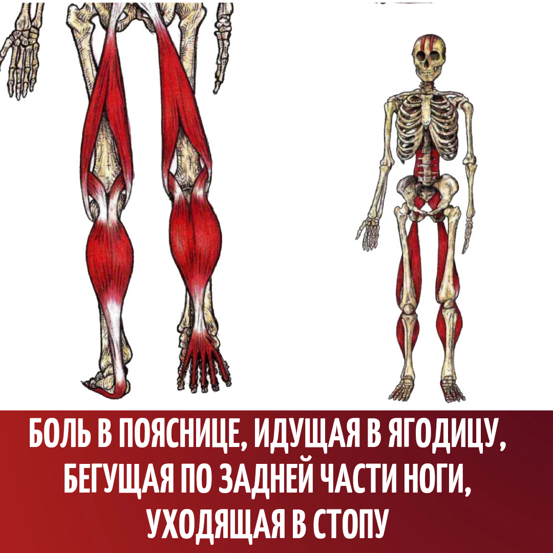 Боль в пояснице ягодице и ноге. Болит поясница. Боль в пояснице уходит в ноги. Реабилитация боли в ногах.