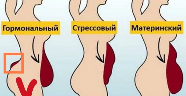 Упражнения для пресса на гормональный живот. Стрессовый живот у женщин. Кортизоловый живот у женщин. Как убрать гормональный животик. Типы живота у женщин.