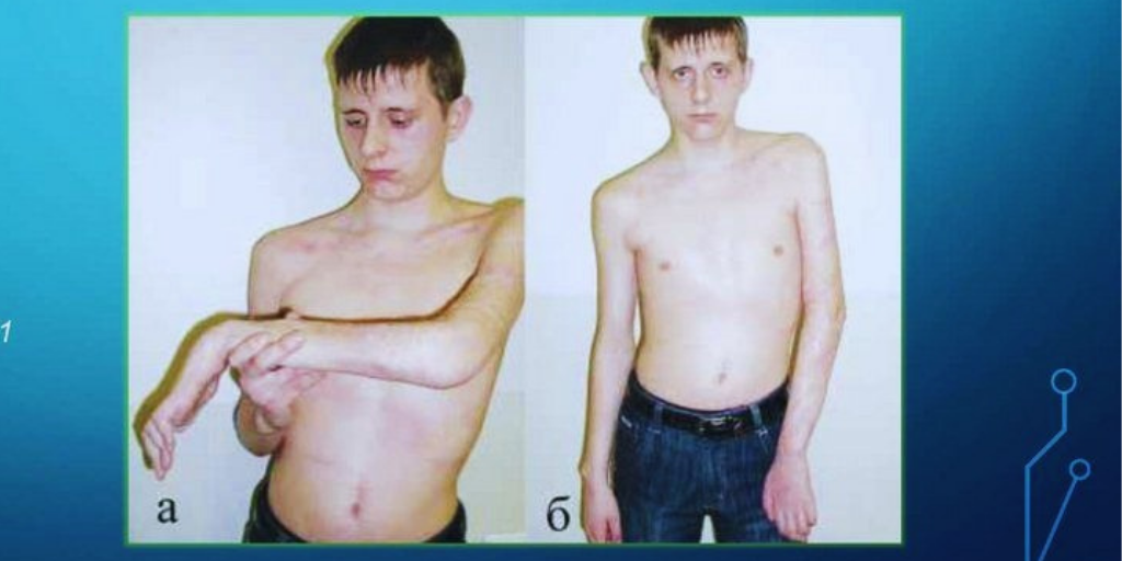 Тотальный паралич руки. Отсутствуют активные движения во всех суставах.