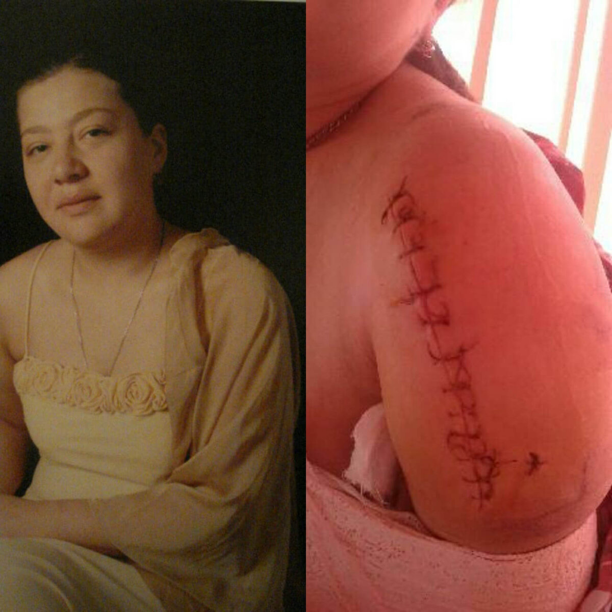 24 августа 2018 года Наталью Сурову на Воробьёвке на пешеходном переходе сбил автомобиль. Девушка получила многочисленные травмы: переломы, выбито несколько зубов, сотрясение мозга.