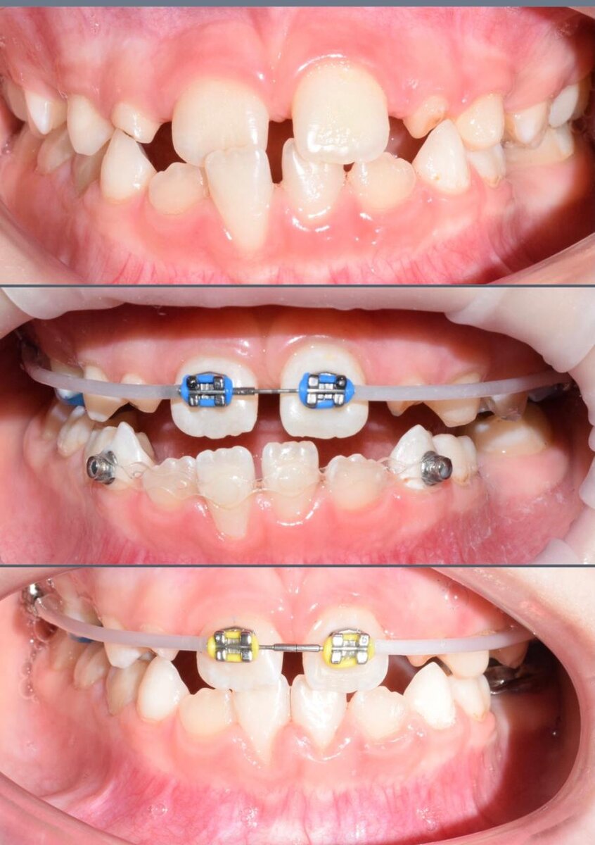 Частично лигатурная брекет-система