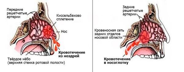 Как лечить переднее носовое кровотечение с помощью тампонады носа