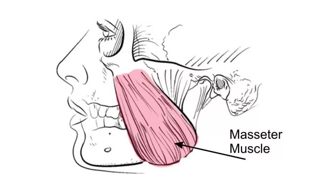 Спазм жевательной мышцы лица. Гипертонус жевательных мышц. Гипертонус мышц челюсти. Гипертонус жевательной мускулатуры. Мышцы челюсти.