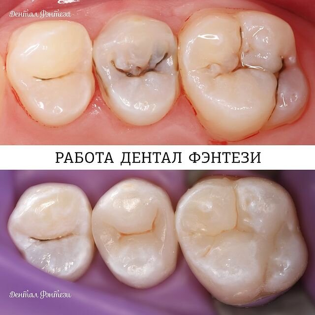 Потемнение в фиссурах. Налёт или кариес? | Записки Честного Стоматолога ...