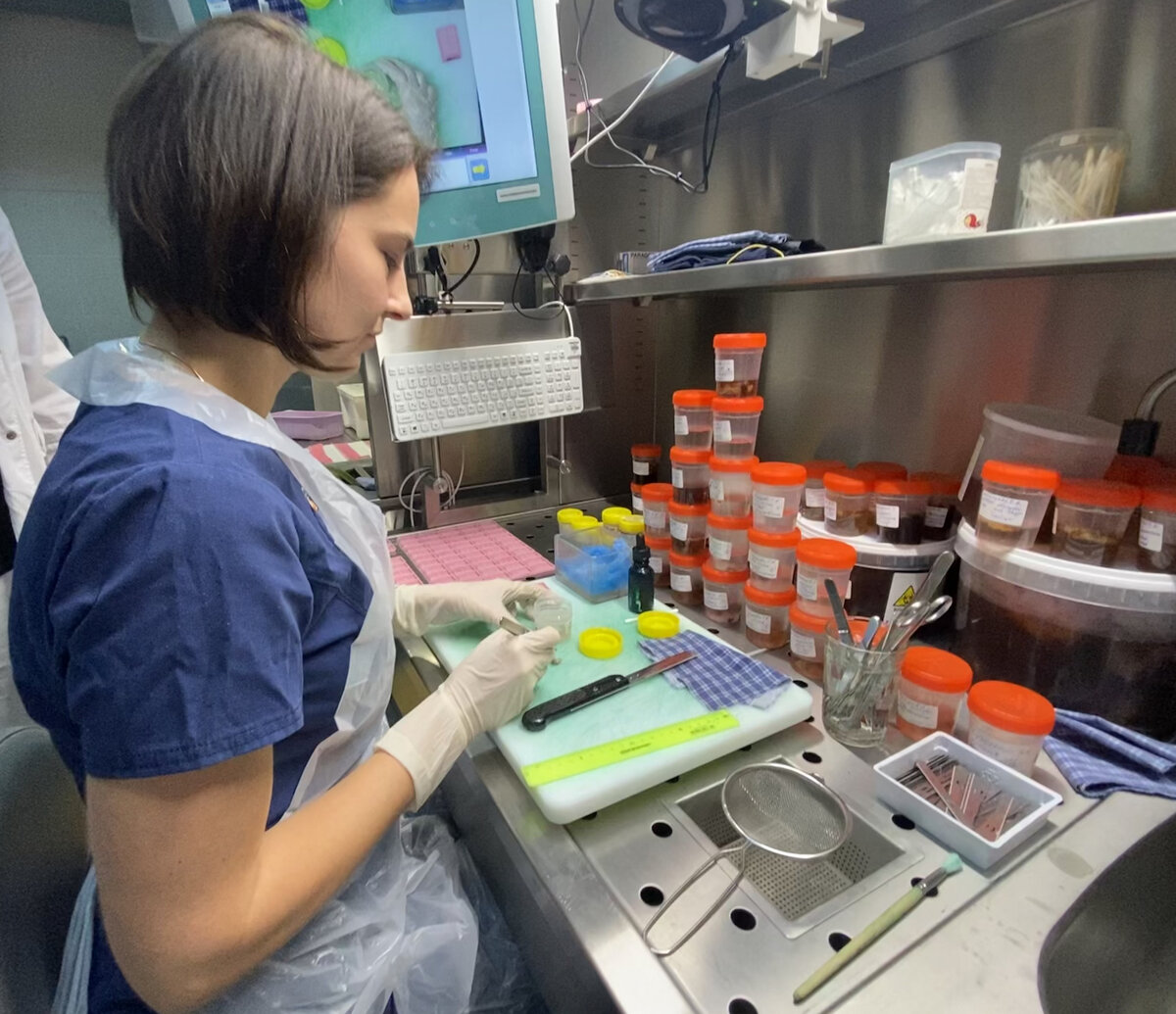 Моя первая вырезка в ординатуре. В этих баночках биопсийный и операционный материал.