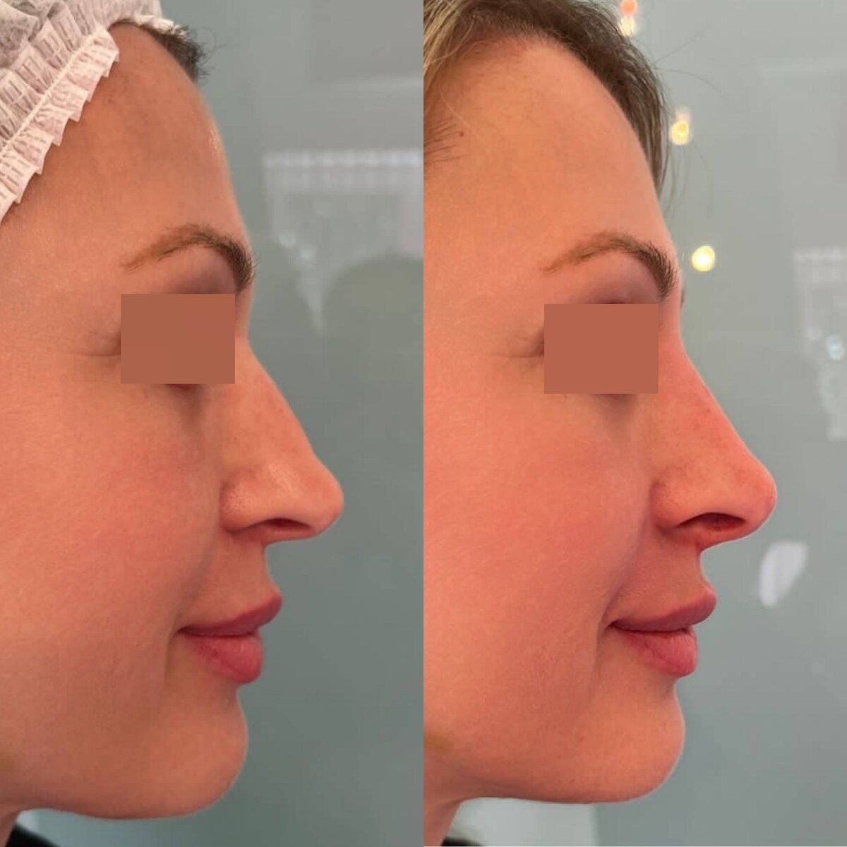 Безоперационная ринопластика - выравнивание спинки носа, коррекция кончика и изменение вектора
