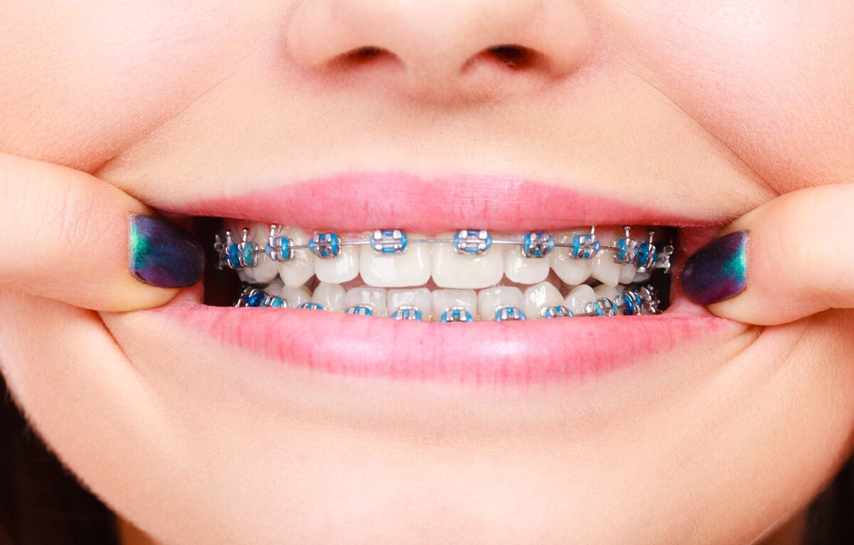 Брекет-система нужна не только для красивой улыбки, но и формирует правильный прикус,  выравнивает сами зубы в один ряд, тем самым предотвращая возможные проблемы с зубами
