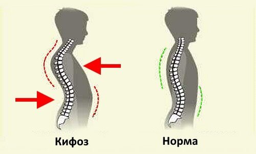 Кифоз это. Кифоз 1 степени грудного отдела позвоночника. Степени кифоза грудного отдела позвоночника. Степени кифоза шейного отдела позвоночника. Патологический грудной кифоз.