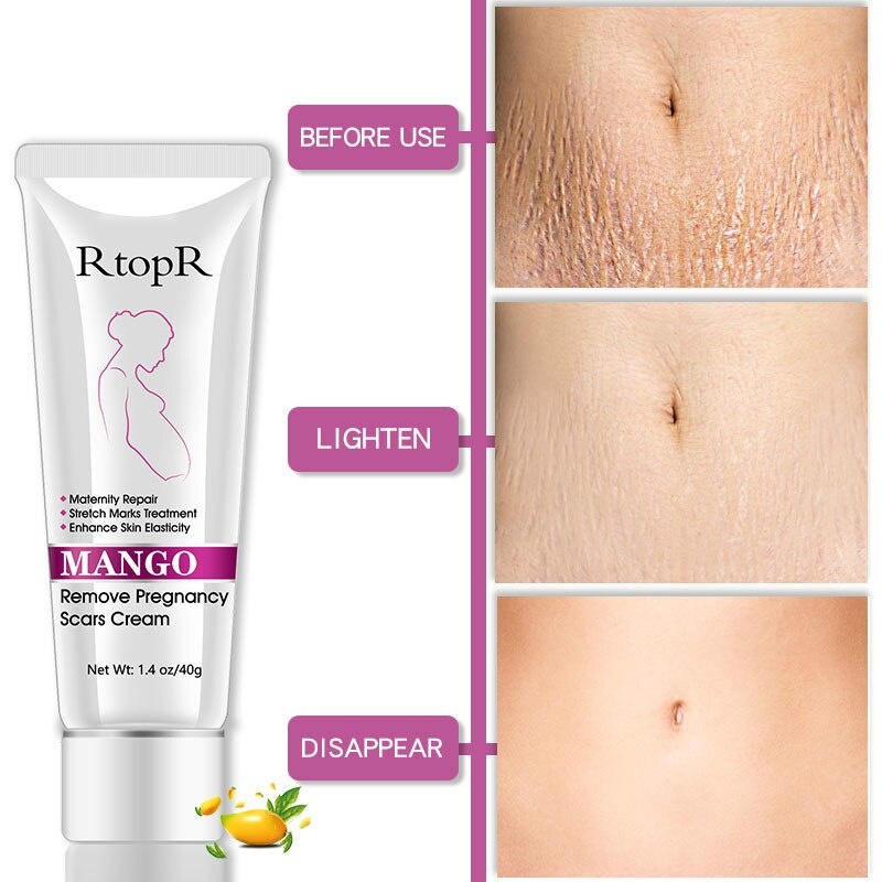 Stretch marks крем от растяжек