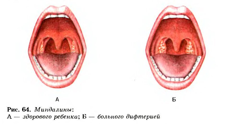 Дифтерия симптомы у детей фото