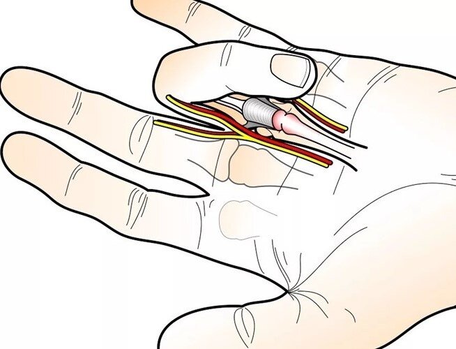 Изображено утолщенное сухожилие, неспособное проскользнуть обратно, чтобы палец разогнулся