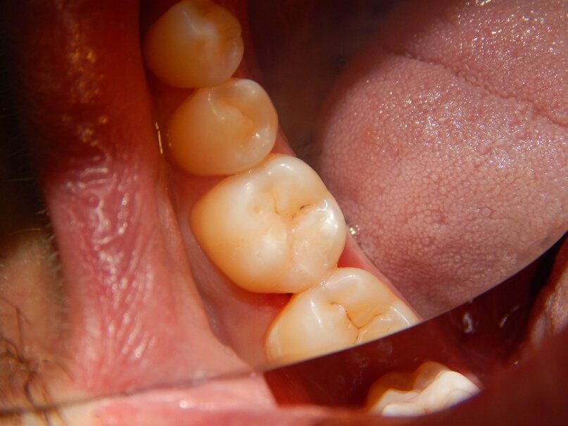 Вид сбоку, после лечения (установлена пломба светового отверждения).