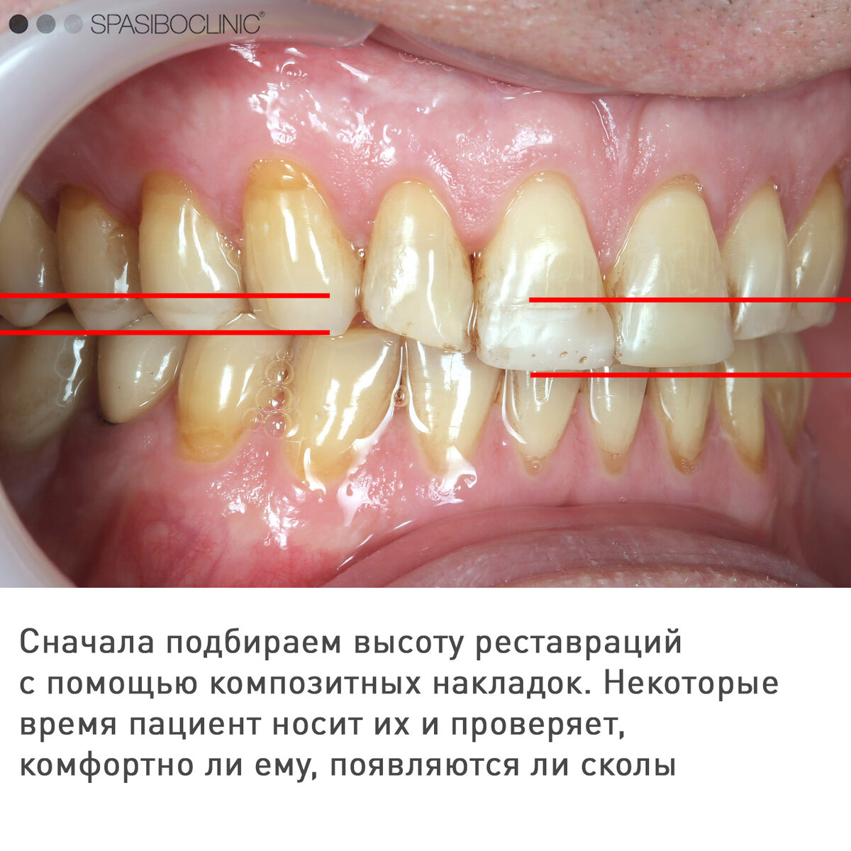 Поможет ли надрез уздечки верхней губы приподнять ее?