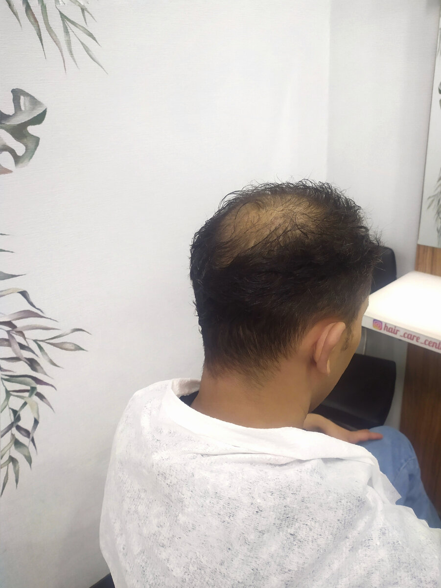 До установки системы. Поредение андрогенное...