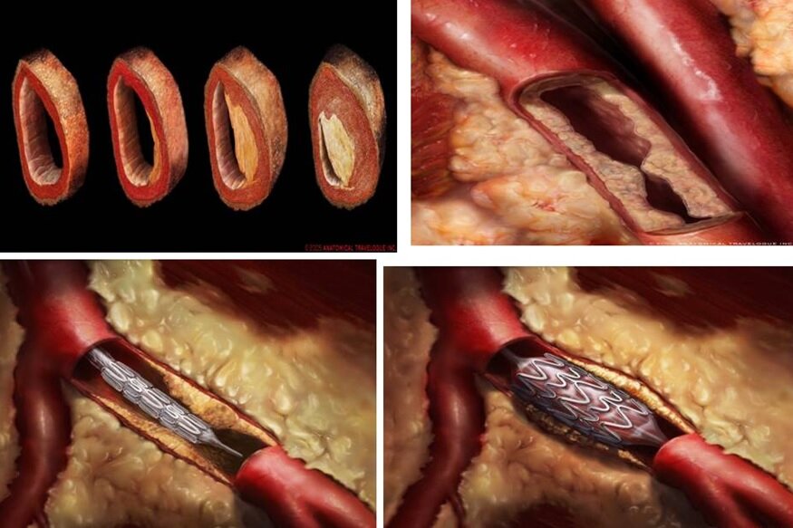 Рис. 1 Бляшки внутри сосуда и лечение путем шунтирования