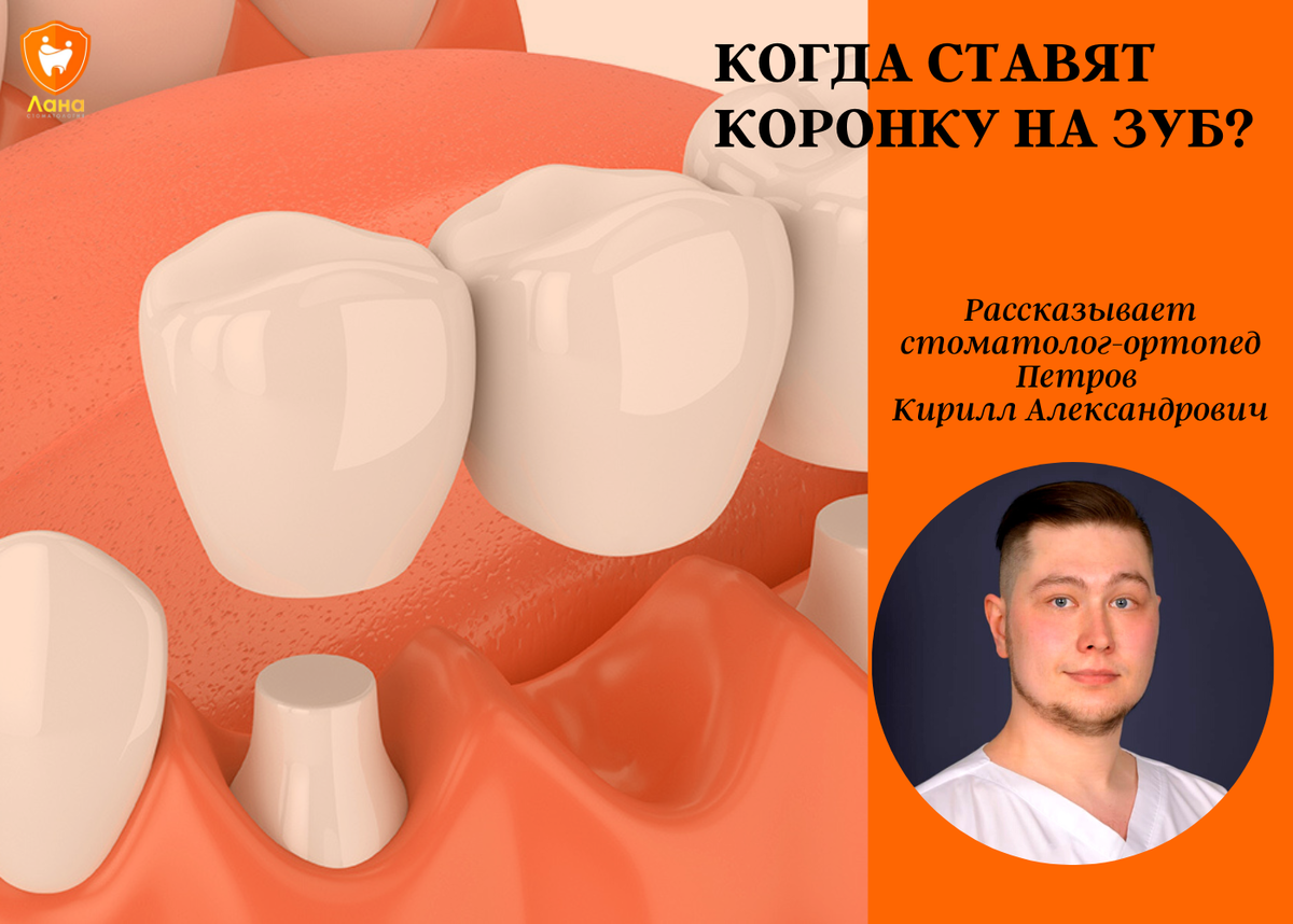 Врач который ставит коронки на зубы называется. Когда ставят коронку на зуб.